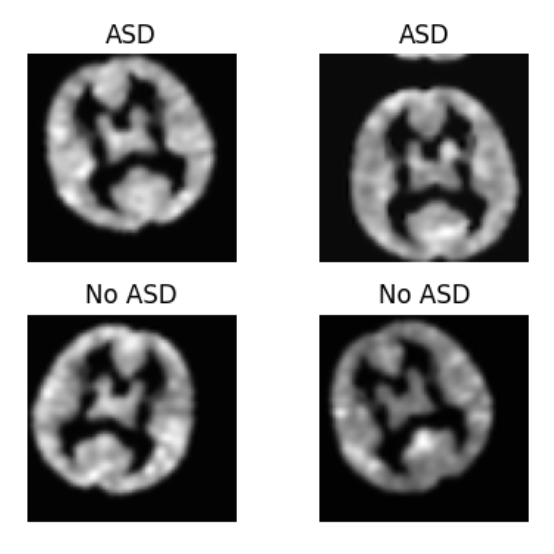 Diagnosing Autism Spectrum Disorder from 3D MRI Images in Pediatric Cases