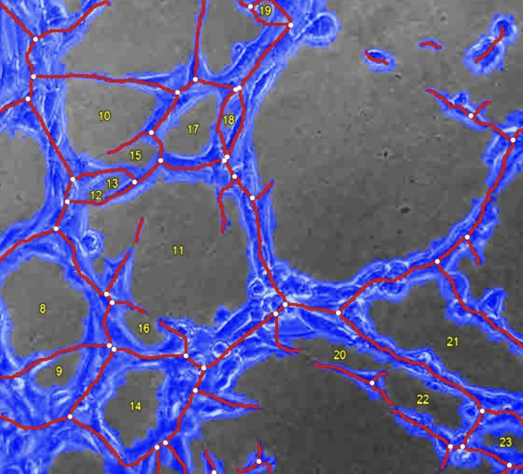 PTENP1: A Pivotal Pseudogene in Glioblastomas